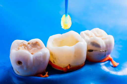 Is It Time to Replace Your Old Fillings?
