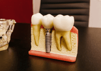 dental implants on brown table