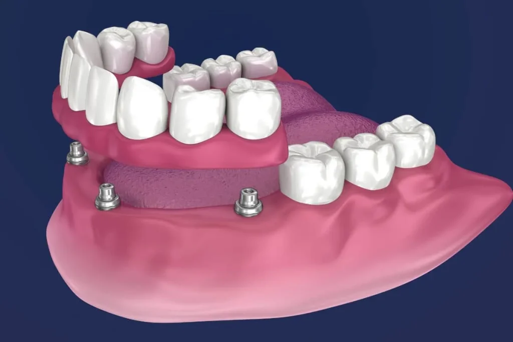 Dental Implants